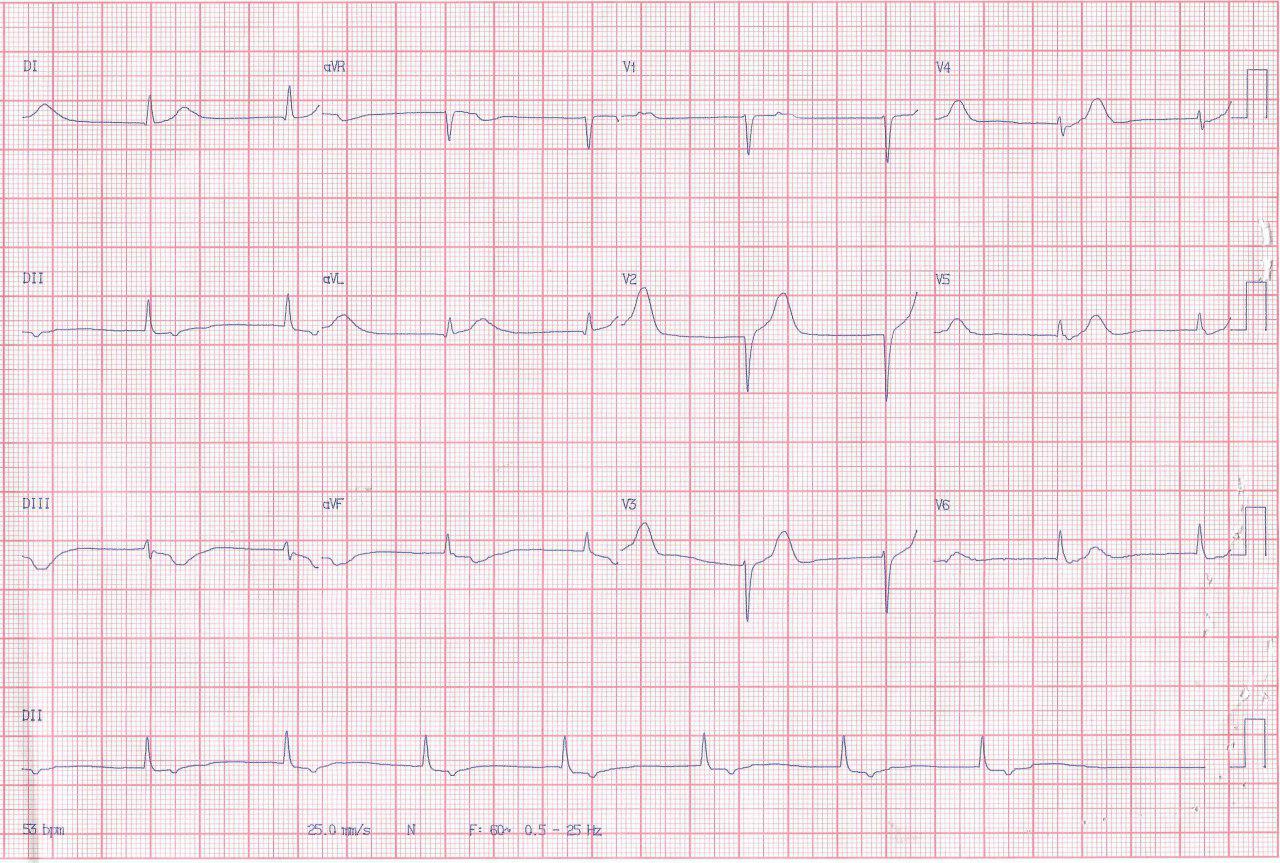 Hombre de 54 años con antecedentes de HTA, hipotiroidismo, miastenia gravis y glaucoma que cursa con angor prolongado por lesión de DA que se angioplastia y posterior desarrollo de TV