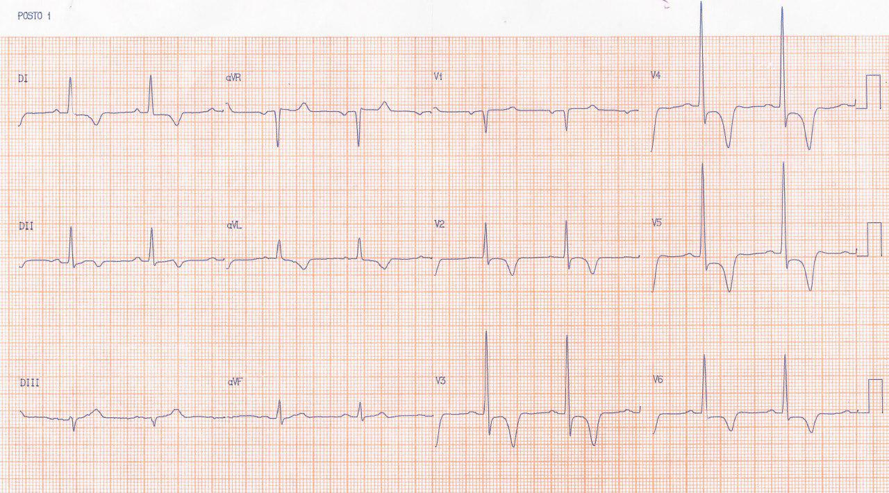 Paciente de 58 años en estudio por presencia de nódulo pulmonar, con precordialgia atípica que presenta lesión de TCI cuyo tratamiento actual será médico