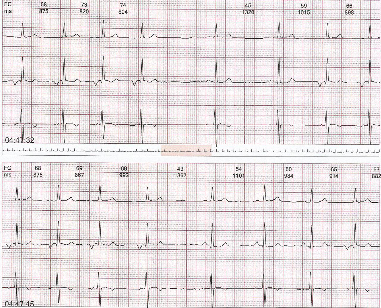 Trazado de Holter de mujer de 24 años con detección de ritmo de aurícula derecha baja