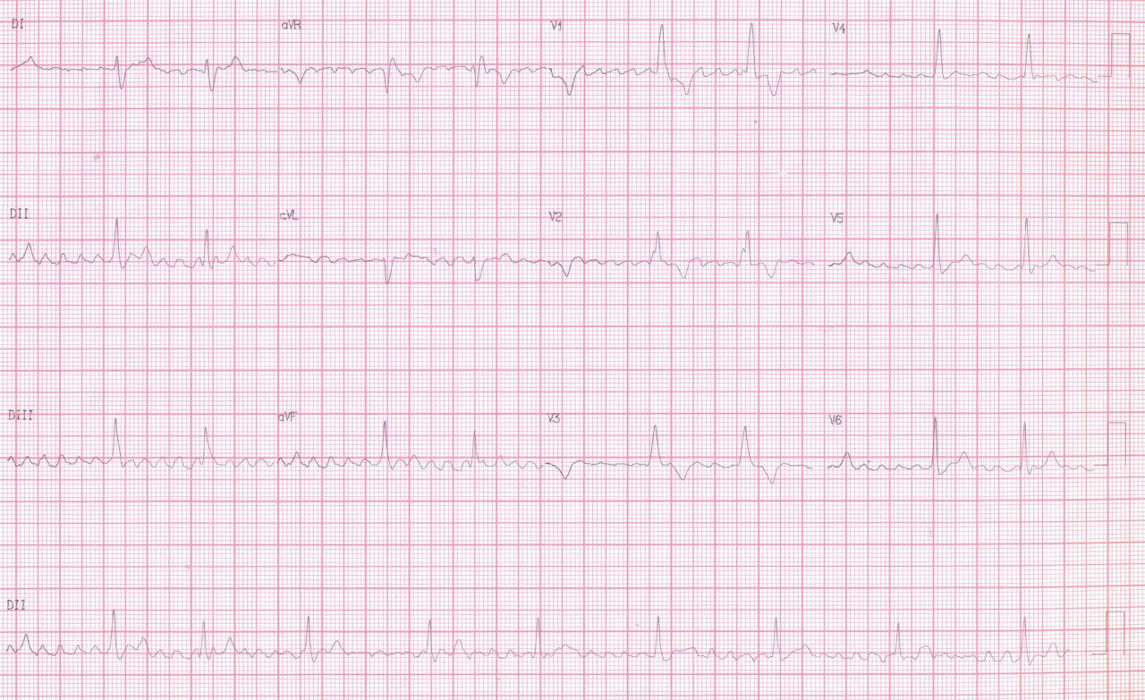 Paciente de 41 años con palpitaciones y síncope en la que se detecta hipertiroidismo que es tratado