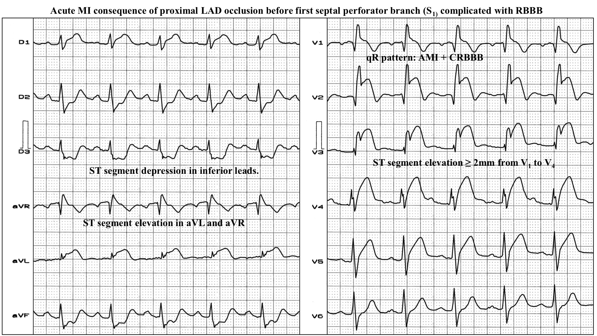 Acute MI consequence of proximal LAD occlusion before first septal perforator branch (S1) complicated with RBBB