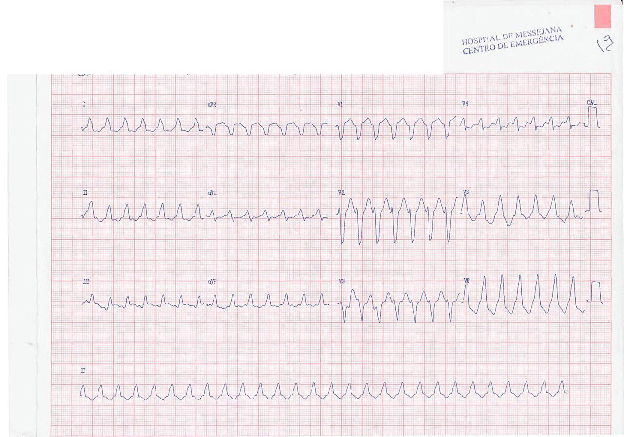 Paciente hipertenso que presenta palpitaciones rápidas por aleteo auricular 1:1 con aberrancia de BCRI que pasa a BAV 2:1 con MSC y luego BAV variable sin aberrancia