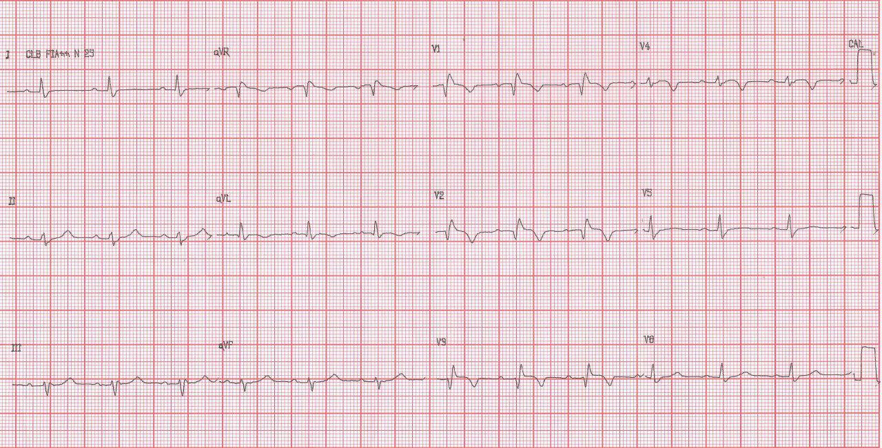 ECGs correspondientes a pre y postoperatorio al 5º día de CRM y endartectectomía carotídea de paciente que evoluciona al coma y fallece por hemorragia cerebral