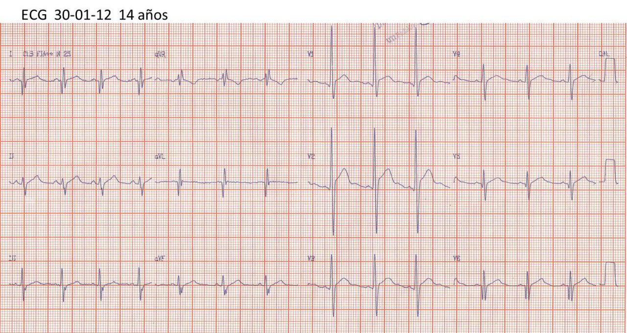 Niño de 14 años que presenta enfermedad de Duchenne