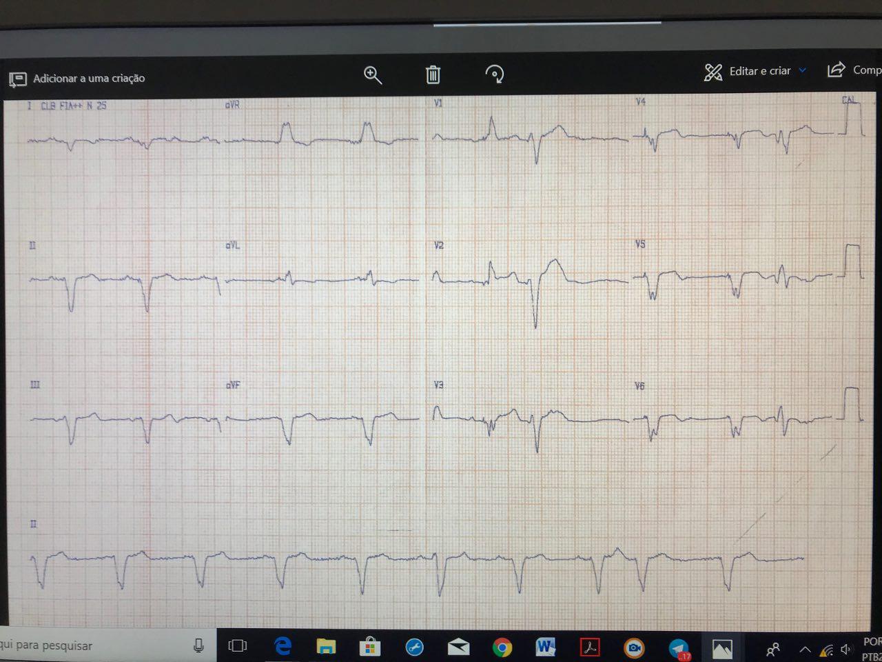 Trazado correspondiente a un resincronizador normofuncionante