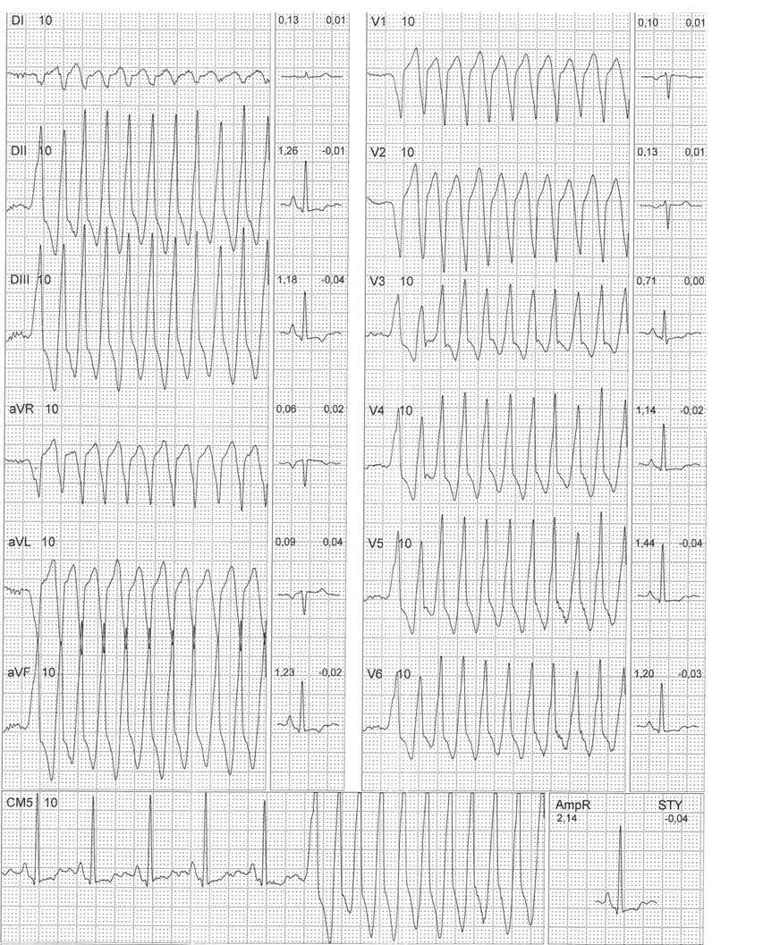 Mujer de 32 años con palpitaciones por presentar episodios de TV y episodio de TSV
