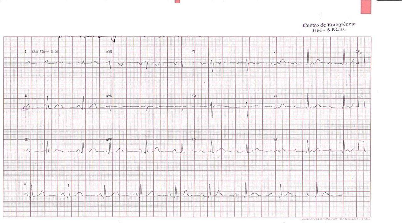 Paciente femenina de 15 años con diagnóstico de BAV congénito desde los 8 años que presenta palpitaciones, disnea y presíncope