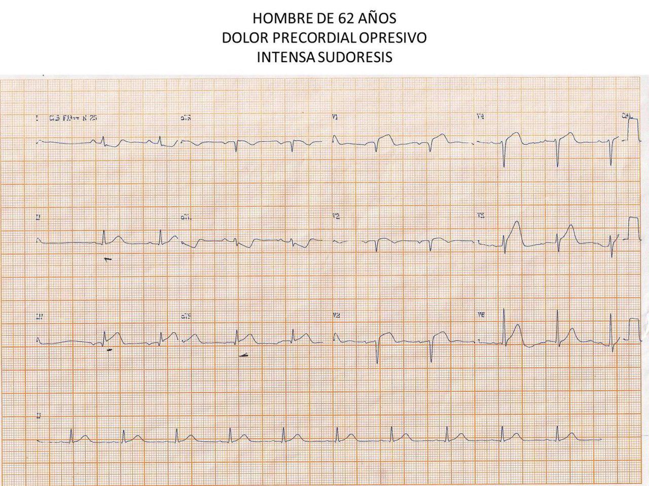 Paciente de 62 años con SCA por suboclusión proximal de la DA antes de la Diagonal con cables de MS intercambiados en primer trazado
