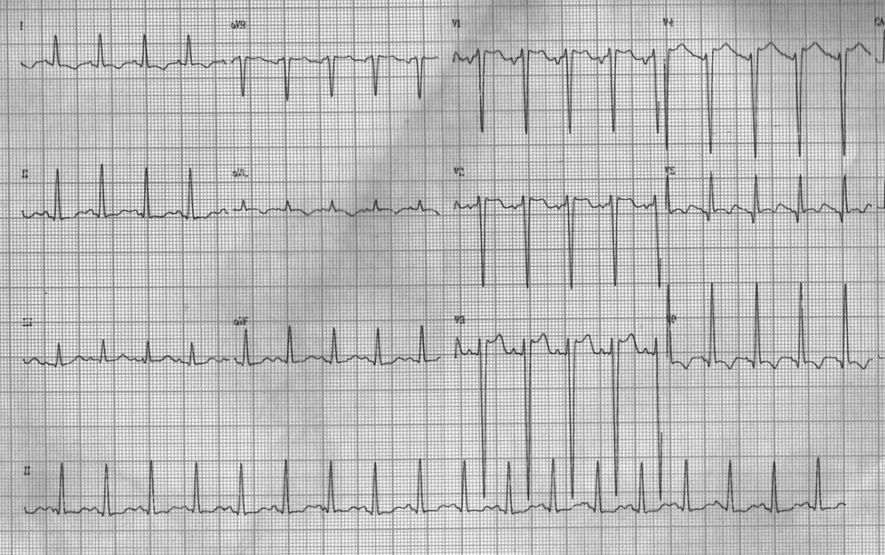 Paciente masculino de 76 años portador de soplo eyectivo aórtico que presenta hipotensióm intraesfuerzo. Coronarias normales en la CCG. Desarrolla episodio de angor de reposo y FV irreversible