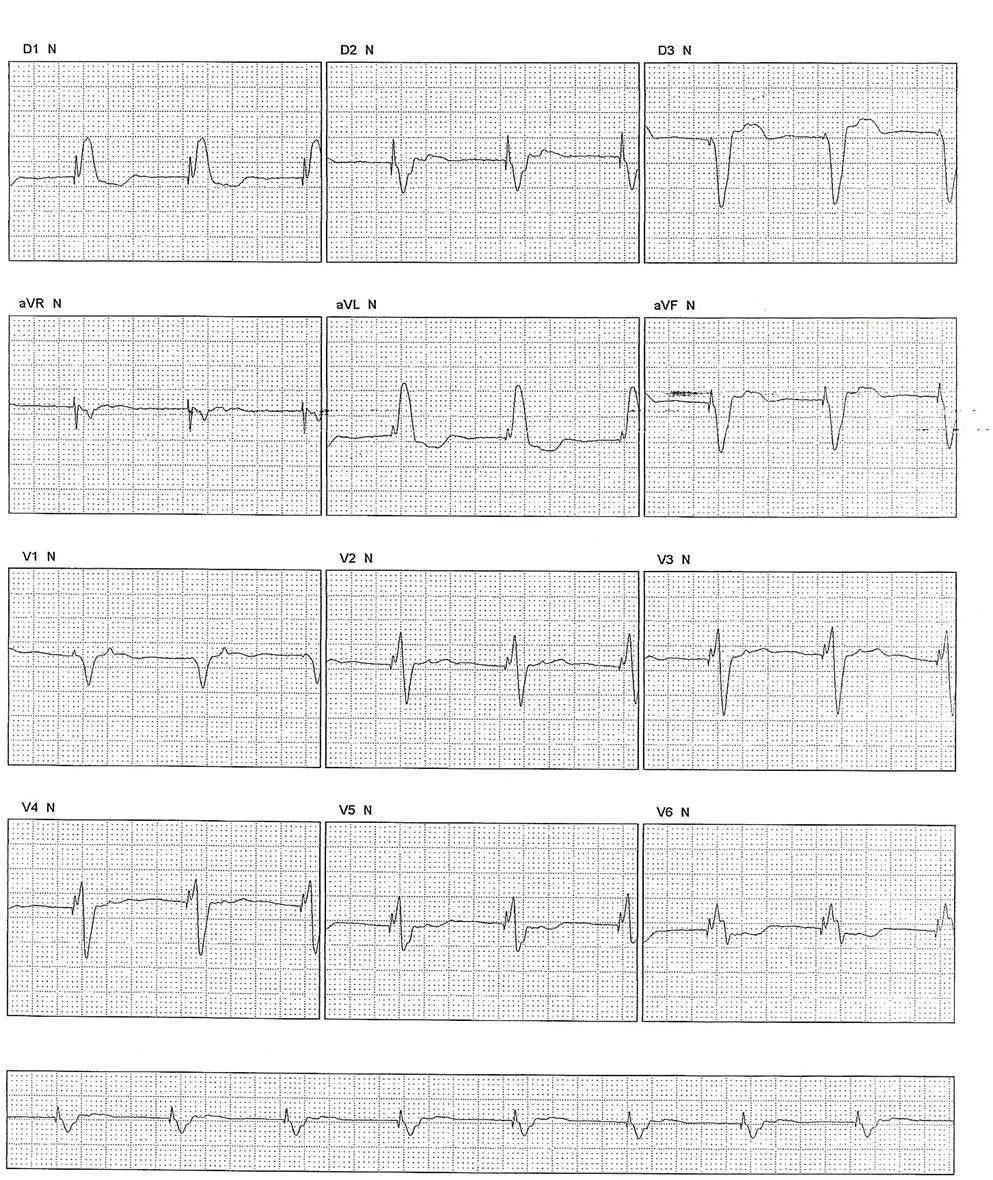 Paciente que 6 semanas a posteriori de implante de MP unicameral con estimulación VVI desarrolla cuadro de disnea por retroconducción VA (síndrome de MP) síntomas que desaparecen al cambiarse el dispositivo a DDD