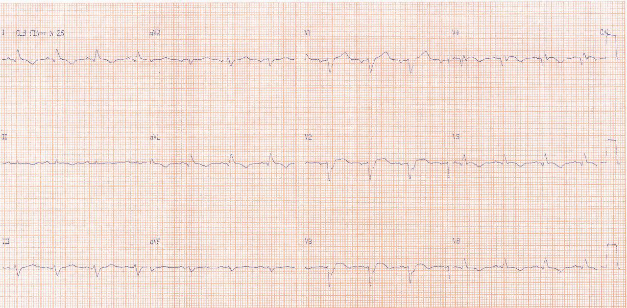 Paciente de 53 años que presenta IAM anterior hace 4 días realizándose PCI presentando déficit neurológico focal con constatación de aneurisma apical del VI con trombo