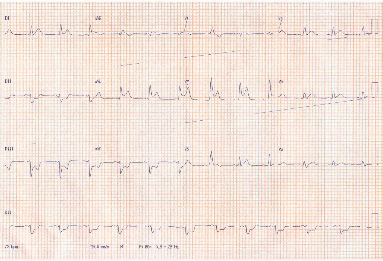 Paciente de 59 años con cuadro de SCA por obstrucción de TCI y DA proximal con trombo que se aspiran y angioplastian