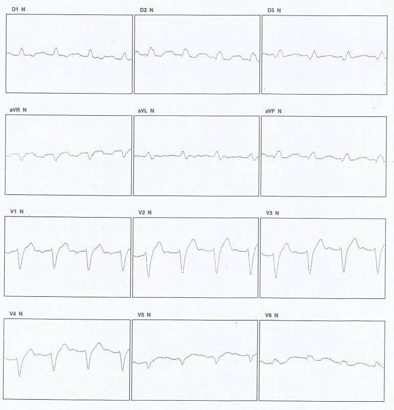 Paciente de 55 años con disnea y palpitaciones que presenta una miocardiopatía no compactada