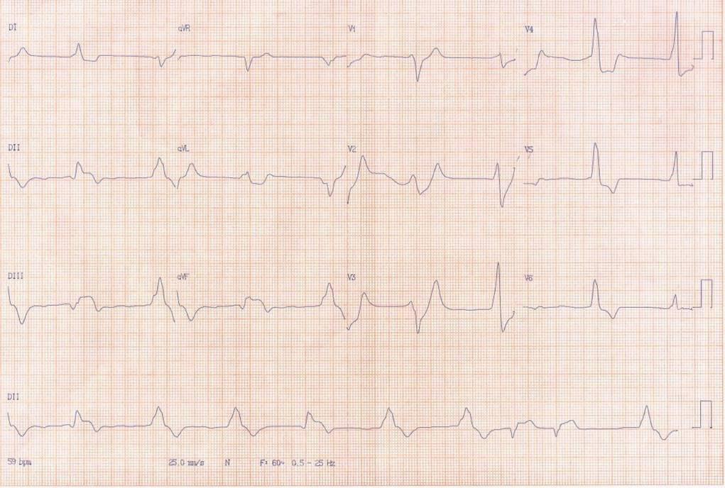 Hombre de 54 años que cursa IAMCEST ínferobasal por compromiso de arteria Cx con imagen especular que evoluciona al shock cardiogénico y óbito