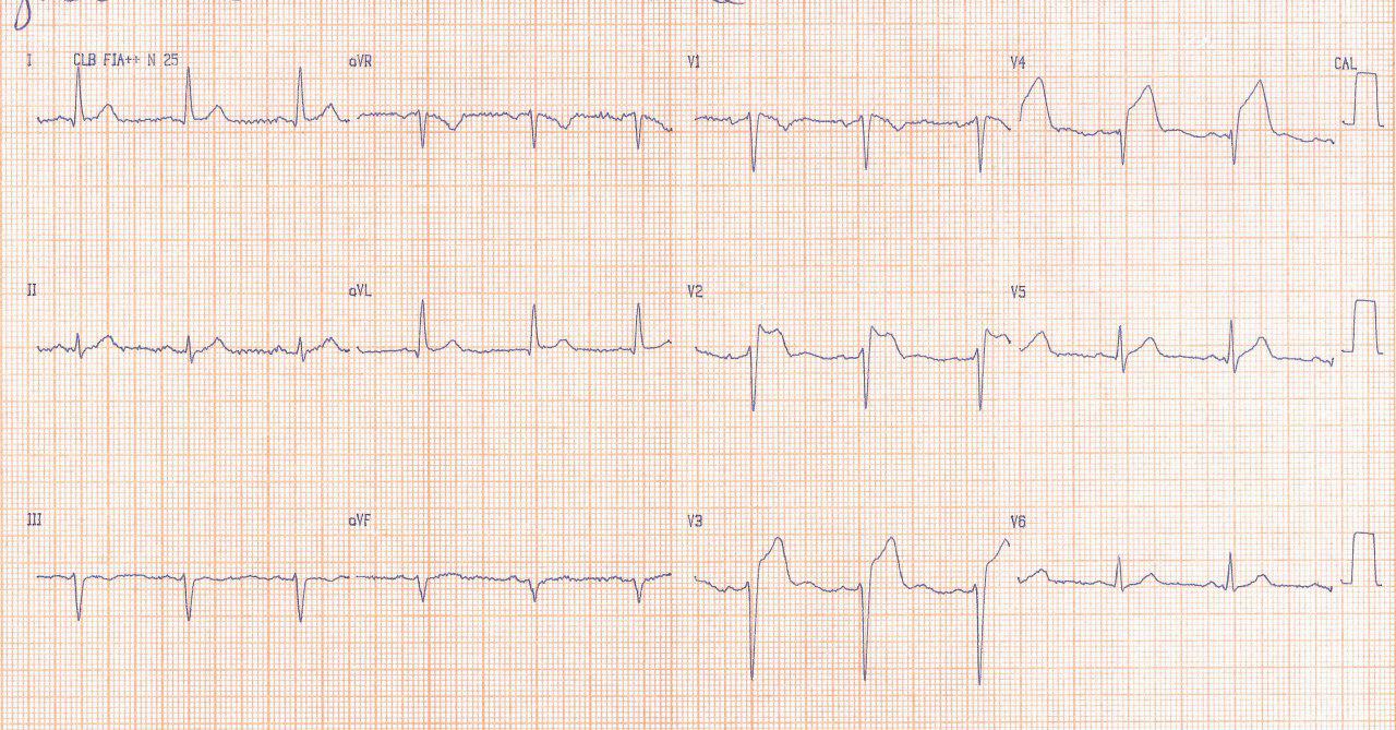 Paciente de 67 años con SCA por compromiso de rama de la Cx, acinesia apical y fenocopia de Brugada concomitante