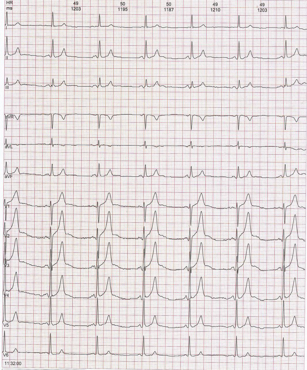Paciente de 62 años, diabético que presenta episodios sincopales por disfunción del nódulo sinusal