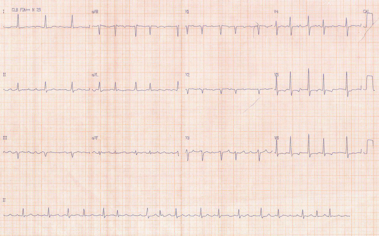 Mujer de 68 años con FR y FA crónica que presenta angor de reciente comienzo progresivo por trombo en DA que se aspira