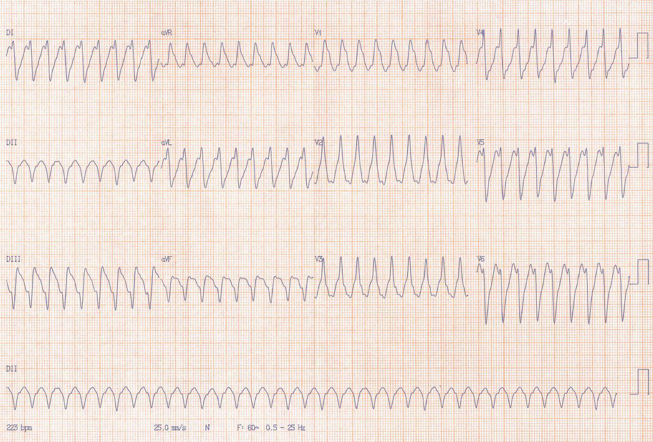 Hombre con antecedentes de SCA e implante de stent fármacoactivo hace 5 meses que presenta taquicardia ventricular que revierte con CVE presentando ritmo de la unión