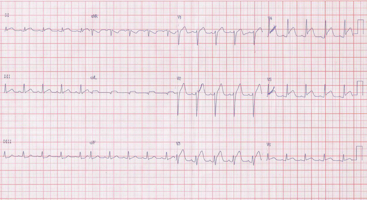 Masculino de 18 años con dolor precordial y aumento de troponina por miopericarditis aguda