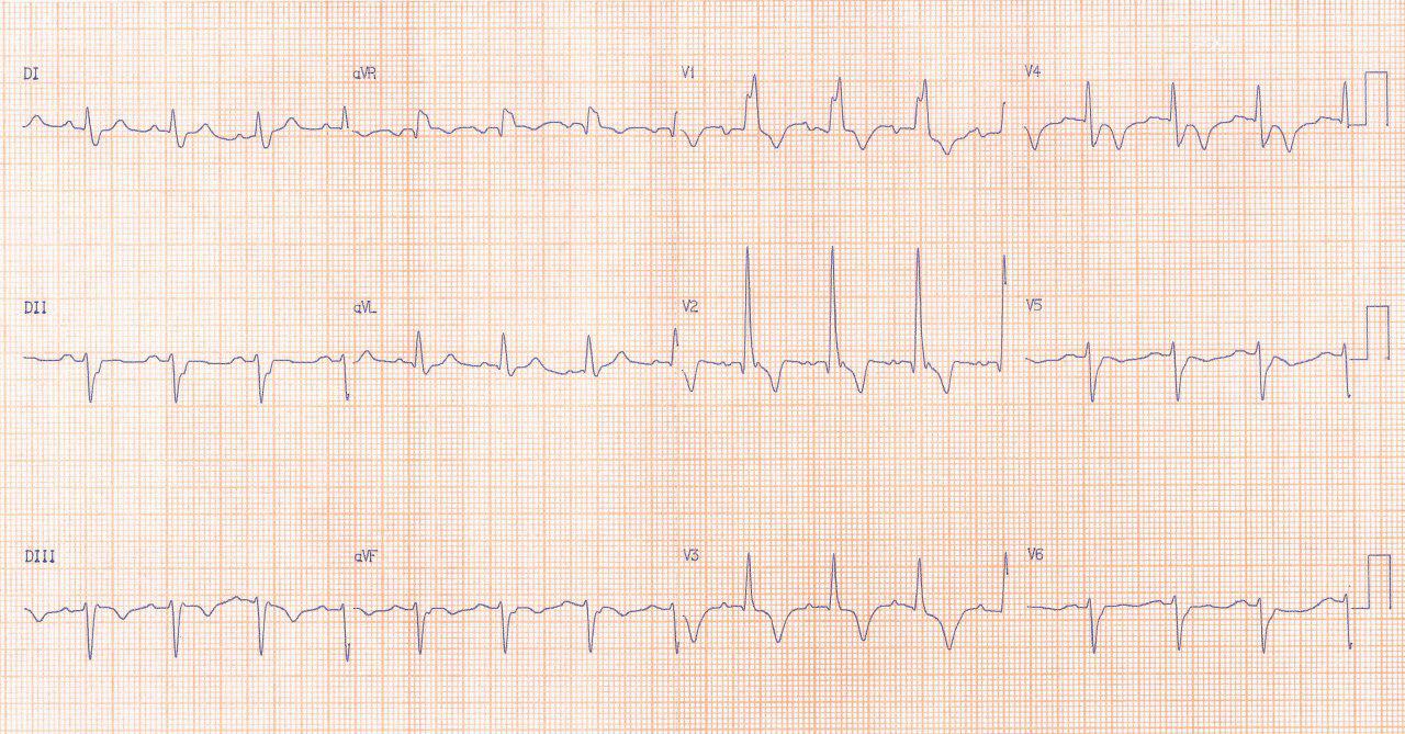 Anciano de 85 años que presenta 2 episodios de caída por bloqueo tetrafascicular