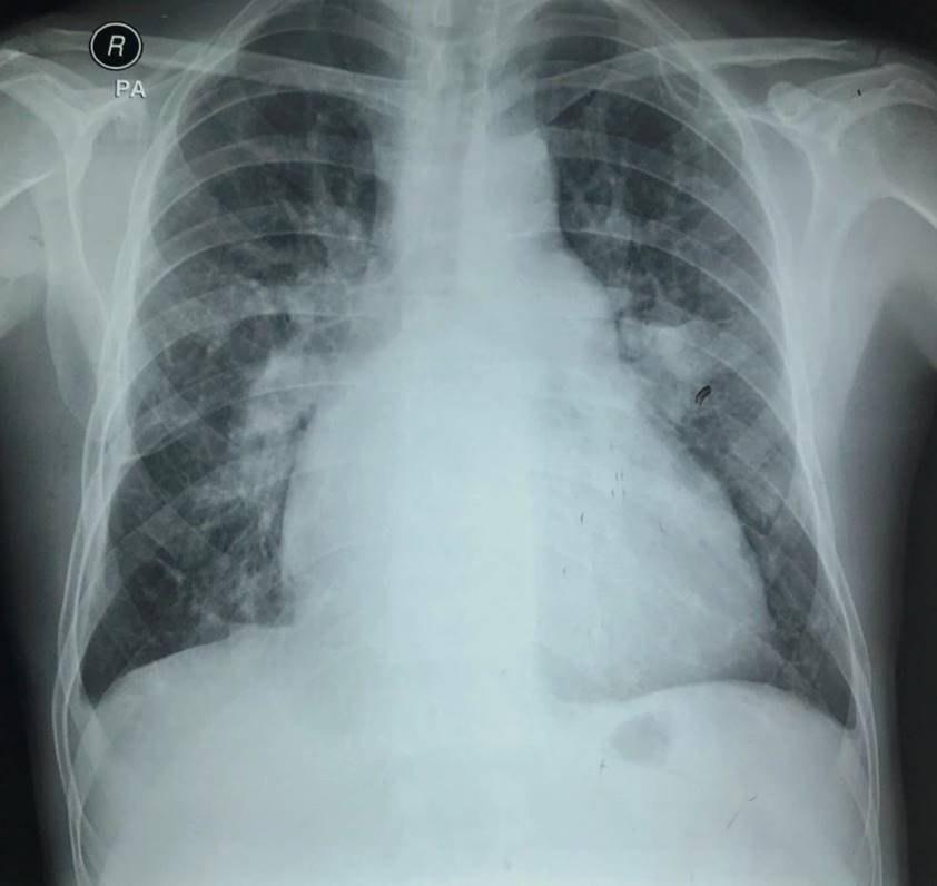 Paciente de 41 años con disnea crónica exacerbada que presenta ductus arterioso persistente