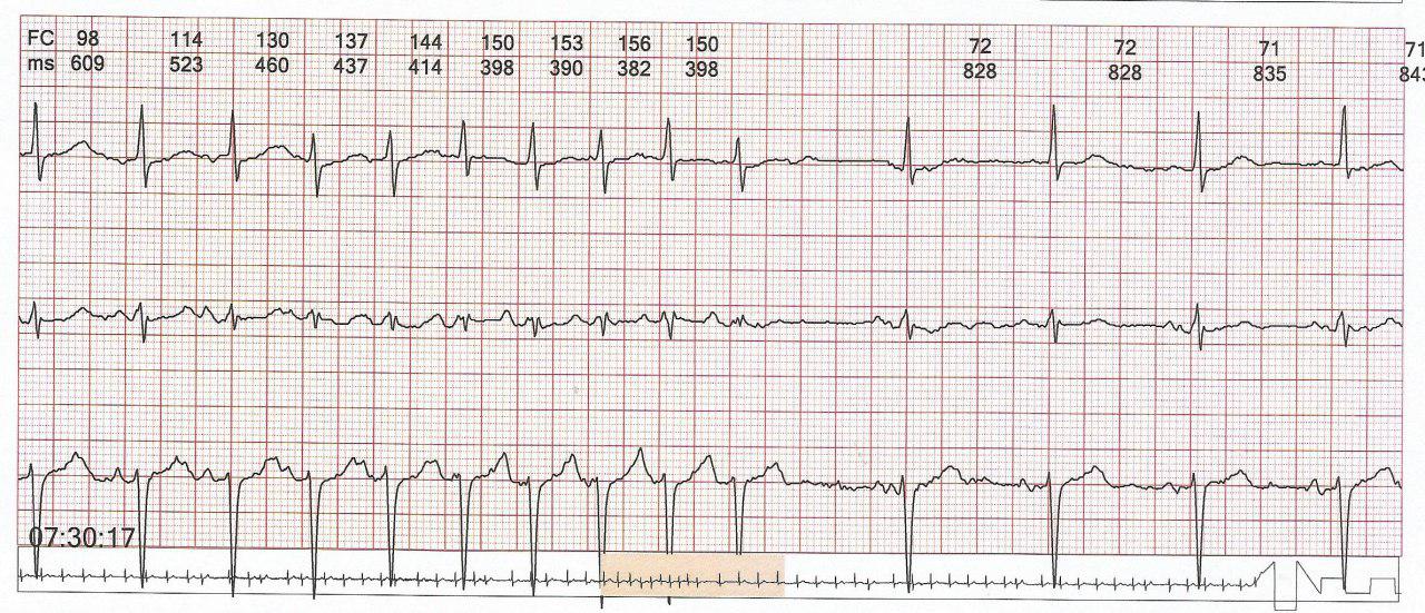 Hombre hipertenso con palpitaciones por presentar taquicardia auricular en el contexto de BIA parcial configurando un Síndrome de Bayes