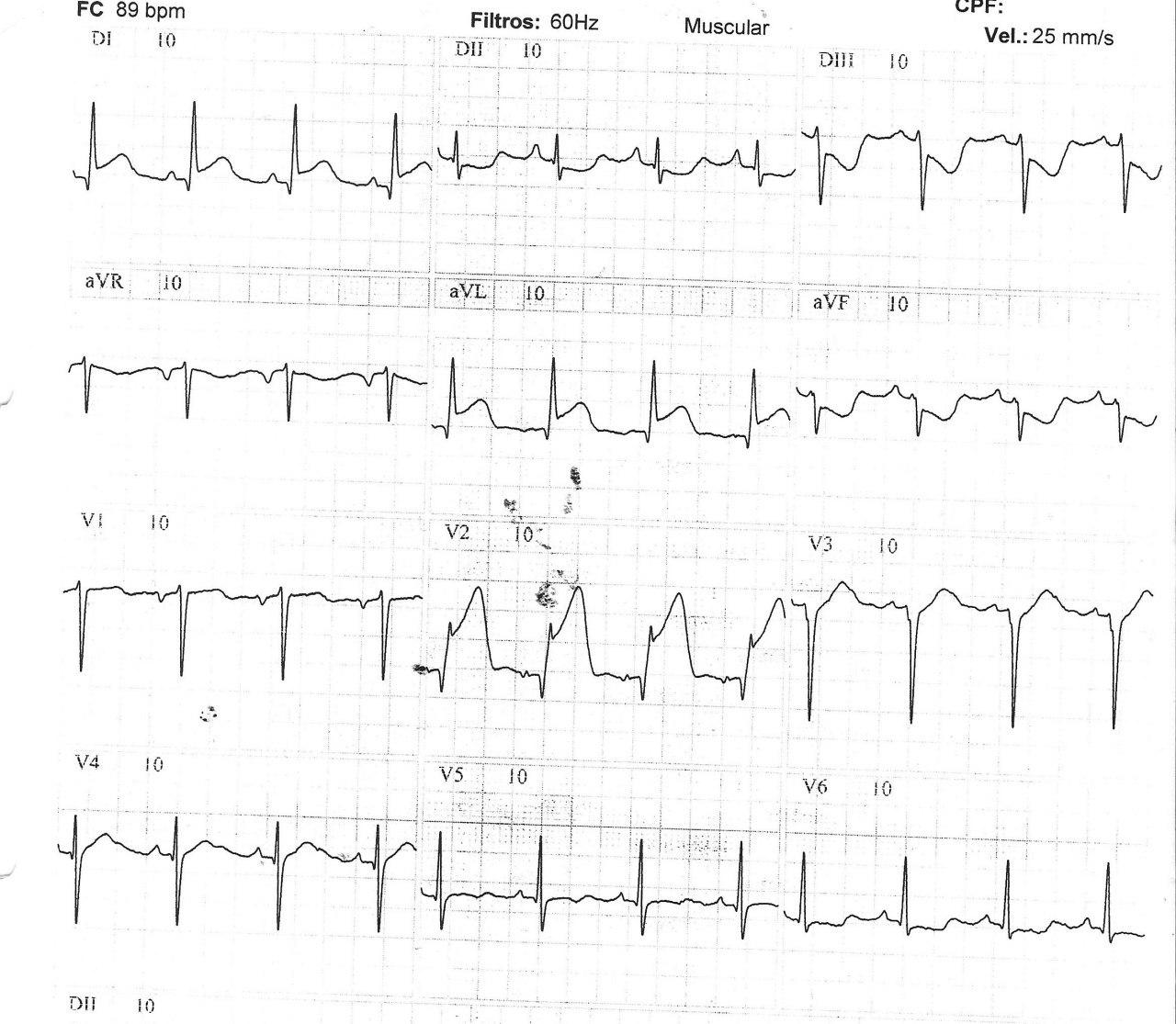 IAM por obstrucción de 1º arteria diagonal de la DA