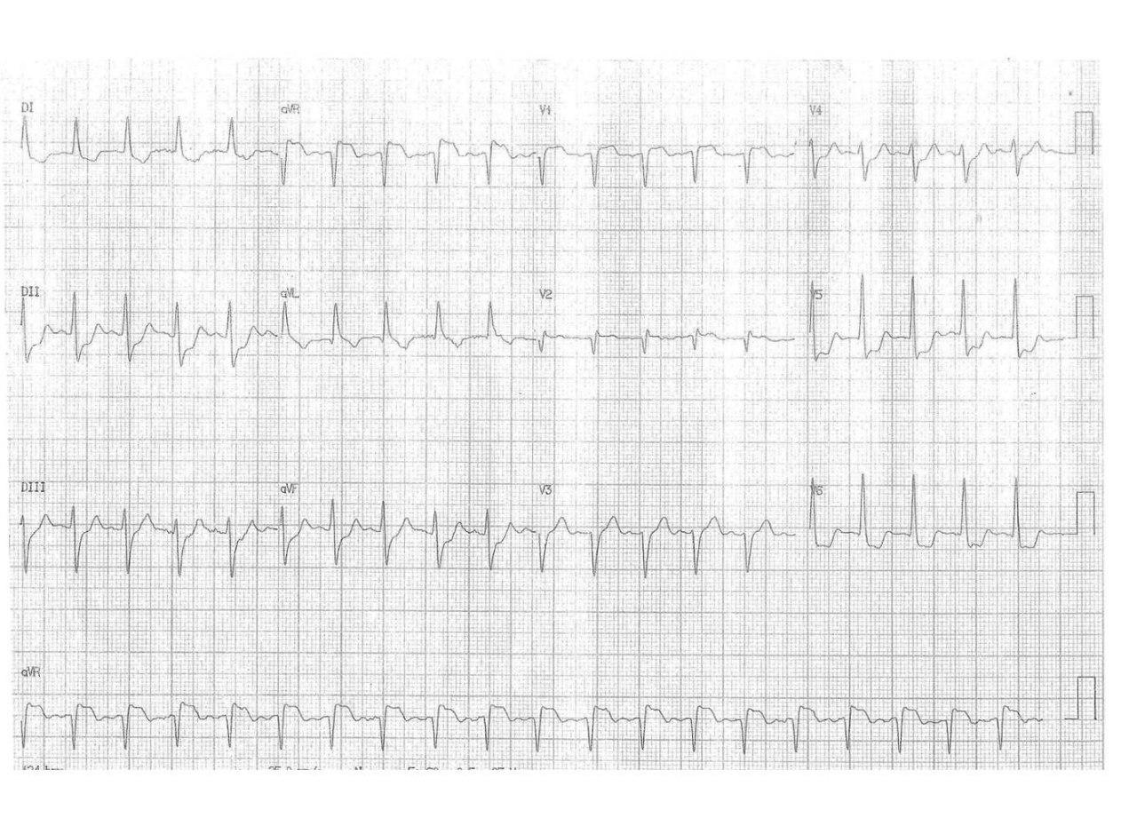 Paciente de 66 años que durante la evolución de erisipela de MI presenta cuadro de diaforesis e insuficiencia respiratoria por isquemia circunsferencial por lesión de TCI, CD y Cx