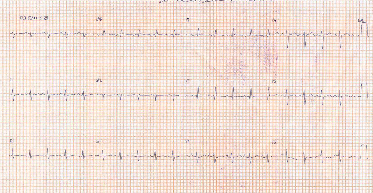 Mujer de 43 años con fatiga, pérdida de peso, palpitaciones y presíncope con 1º R cardíaco fuerte en la auscultación que presenta mixoma de aurícula izquierda