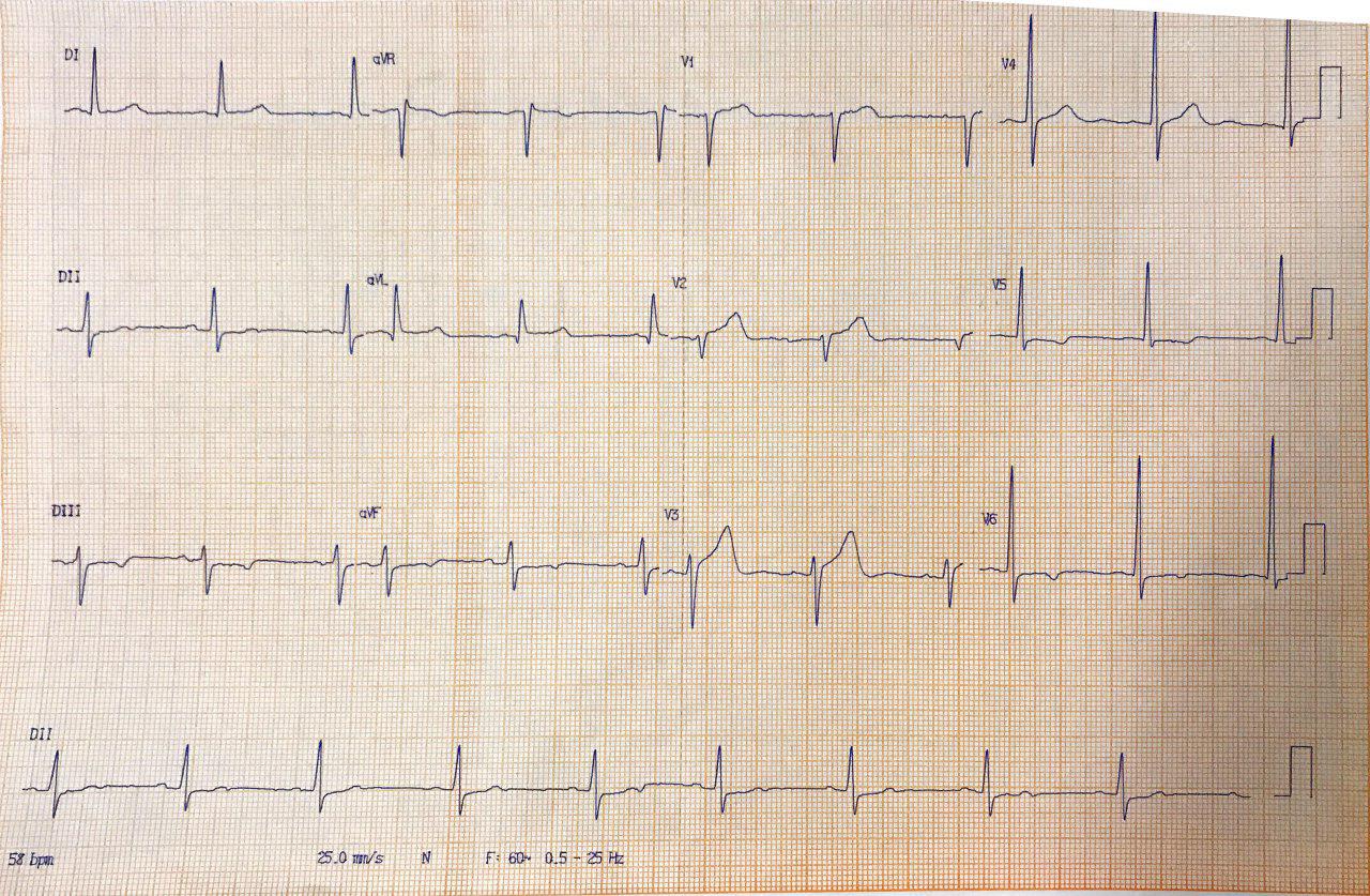 Paciente con dolor interescápulovertebral que acompaña a crisis hipertensiva debido a disección aórtica con compromiso del arco