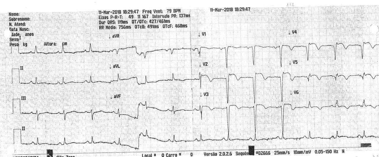 Paciente de 75 años con angor y disnea con antecedentes de infarto previo que presenta obstrucción total de la arteria DA y presencia de aneurisma de cara anterior de VI