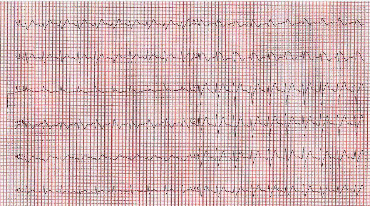 Paciente de 61 años que durante episodio febril con dolor pleurítico pone de manifiesto un patrón de Brugada tipo I que desaparece al controlarse la temperatura