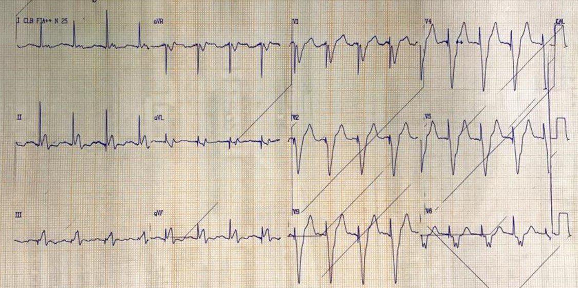 Paciente portador de MP con angor prolongado y presencia de supradesnivel discordante de ST > de 5 mm por suboclusión en la bifurcación entre DA y arteria diagonal y oclusión total de CD