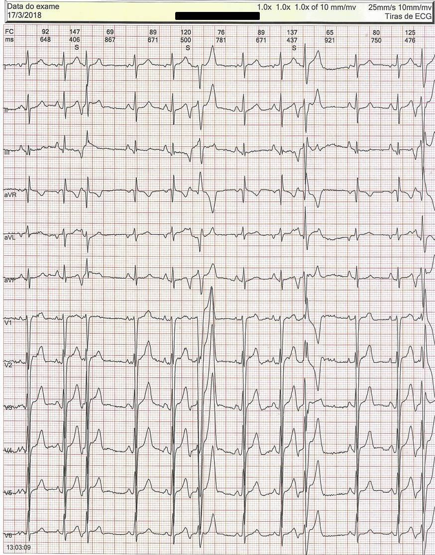 Varón de 16 años con palpitaciones por presentar ESV muy frecuente, bloqueadas, por presencia de aneurisma de séptum interauricular
