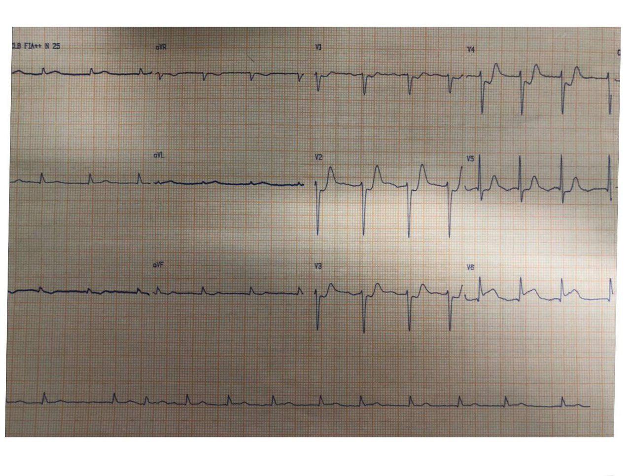 Paciente de 86 años con SCA por presencia de trombo en la bifurcación del TCI que es aspirado exitosamente