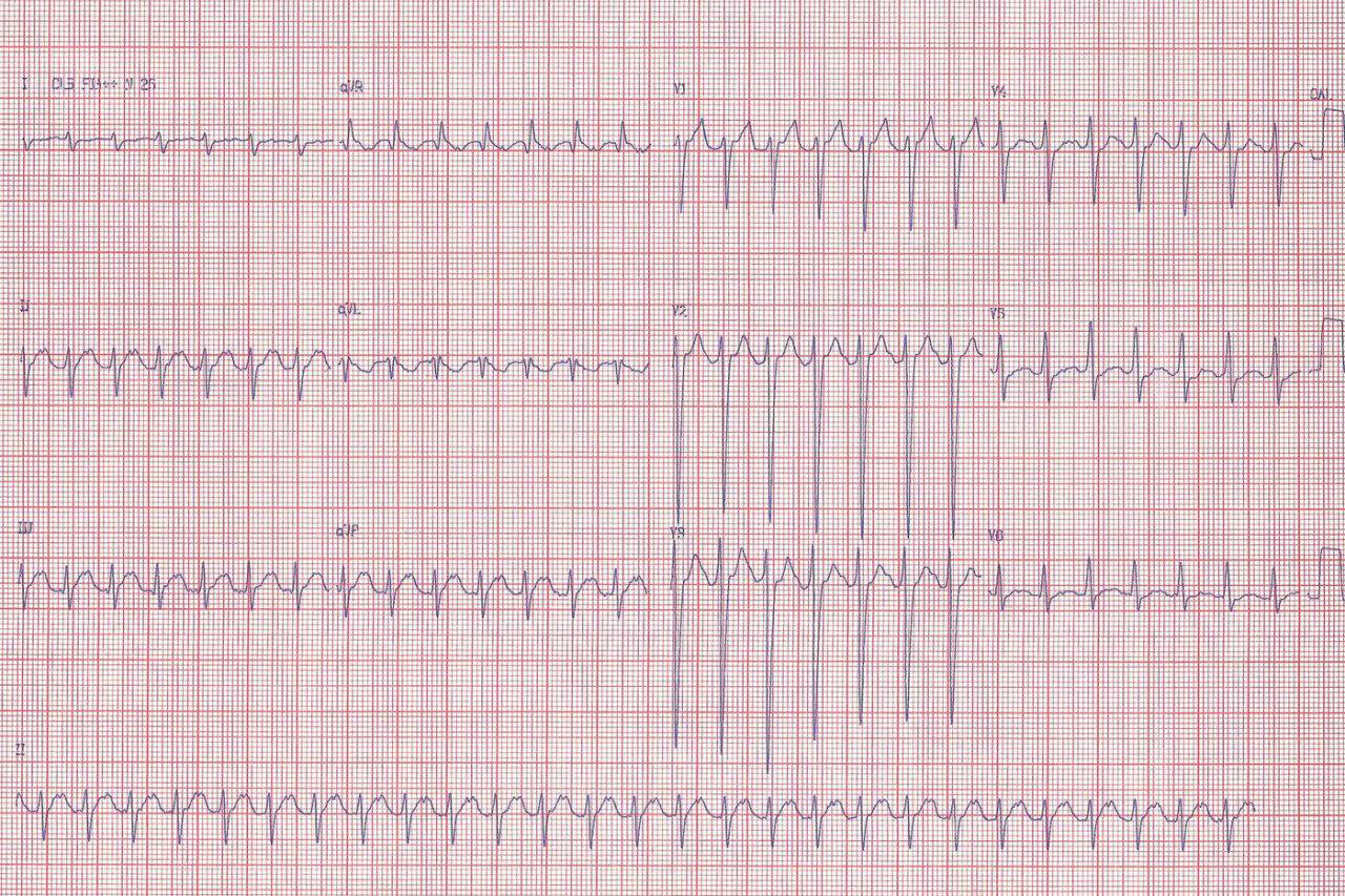 Paciente de 27 años con frecuentes episodios de taquicardia auricular que durante el procedimiento de ARF se complica con BAVC que requiere impante de MP DDDR