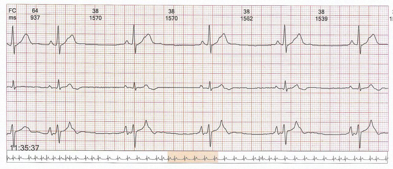 Paciente de 46 años que presenta ESV fecuente, en ocasiones bloqueadas determinando ritmo bradicárdico que posteriormente presenta AA atípico y más tarde EVs frecuentes
