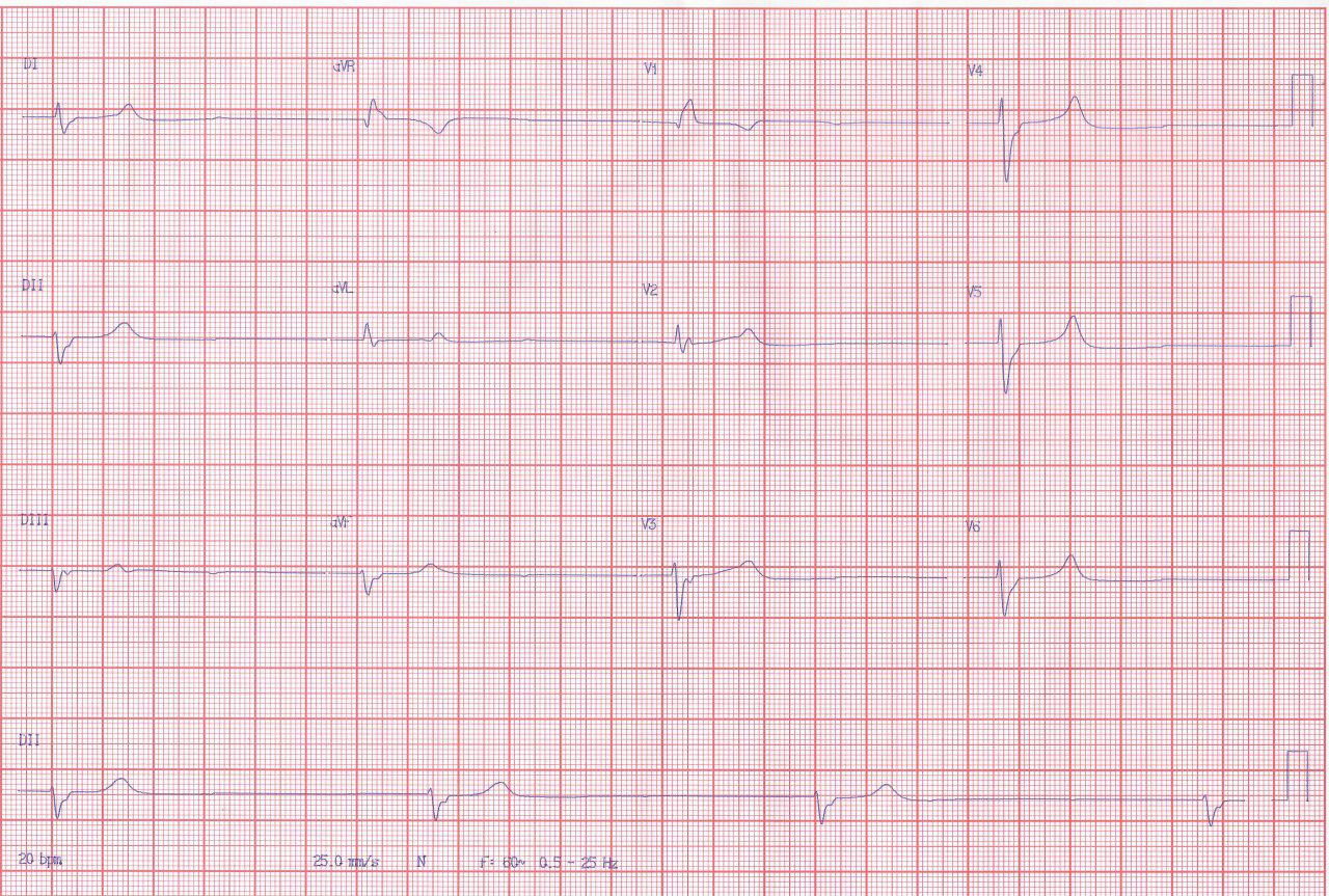 Masculino con cuadro de insuficiencia renal crónica e hiperpotasemia presenta presíncope por presencia de ritmo bradicárdico