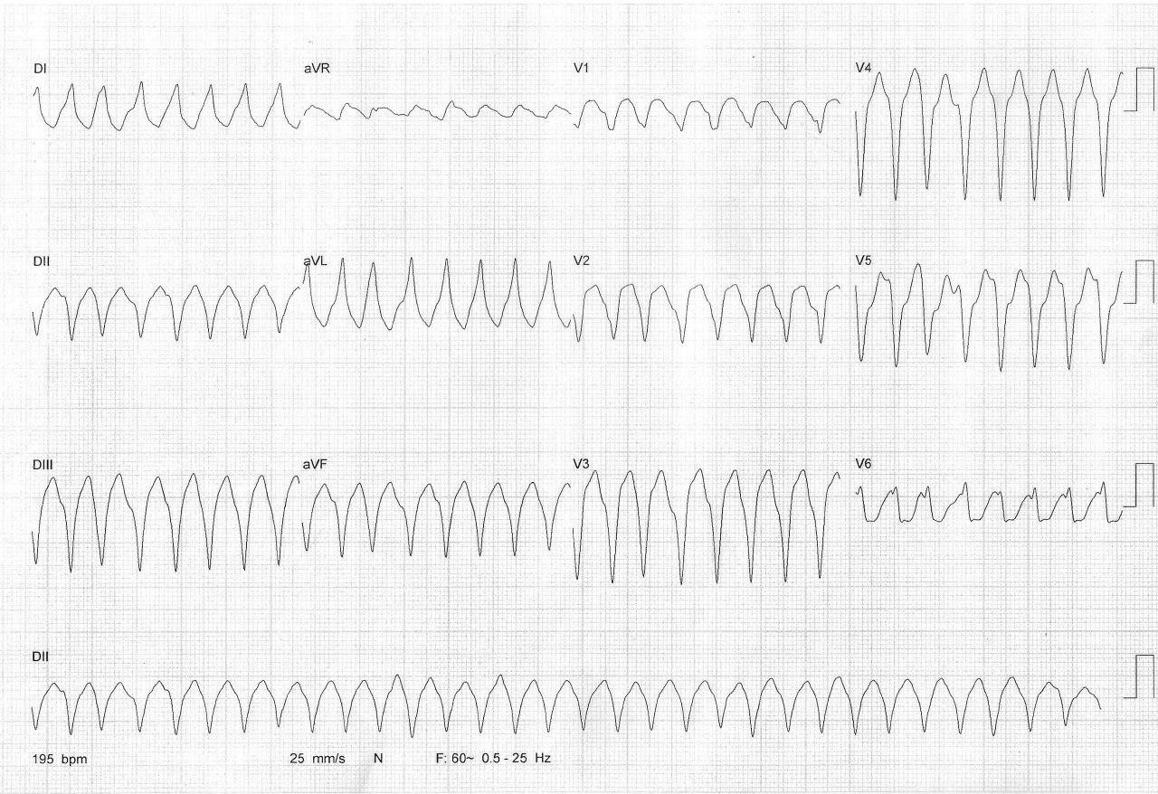 Masculino de 50 años portador de Enfermedad de Chagas que presenta TV con inestabilidad hemodinámica que requiere CVE