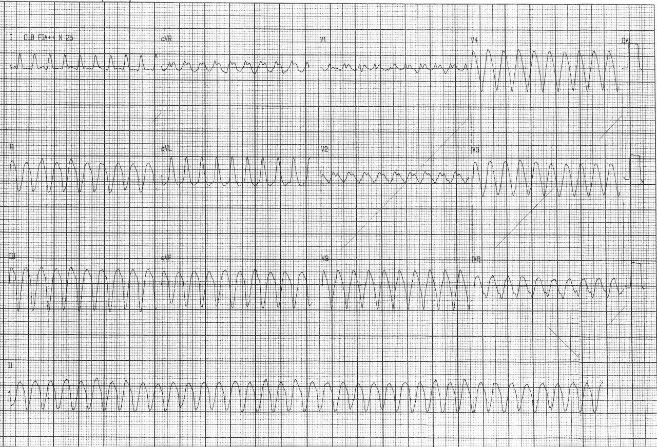 Paciente de 61 años con FR que presenta disnea y episodios sincopales debidos a AA 1:1 que debe revertirse por obstrucción crónica de DA 100%