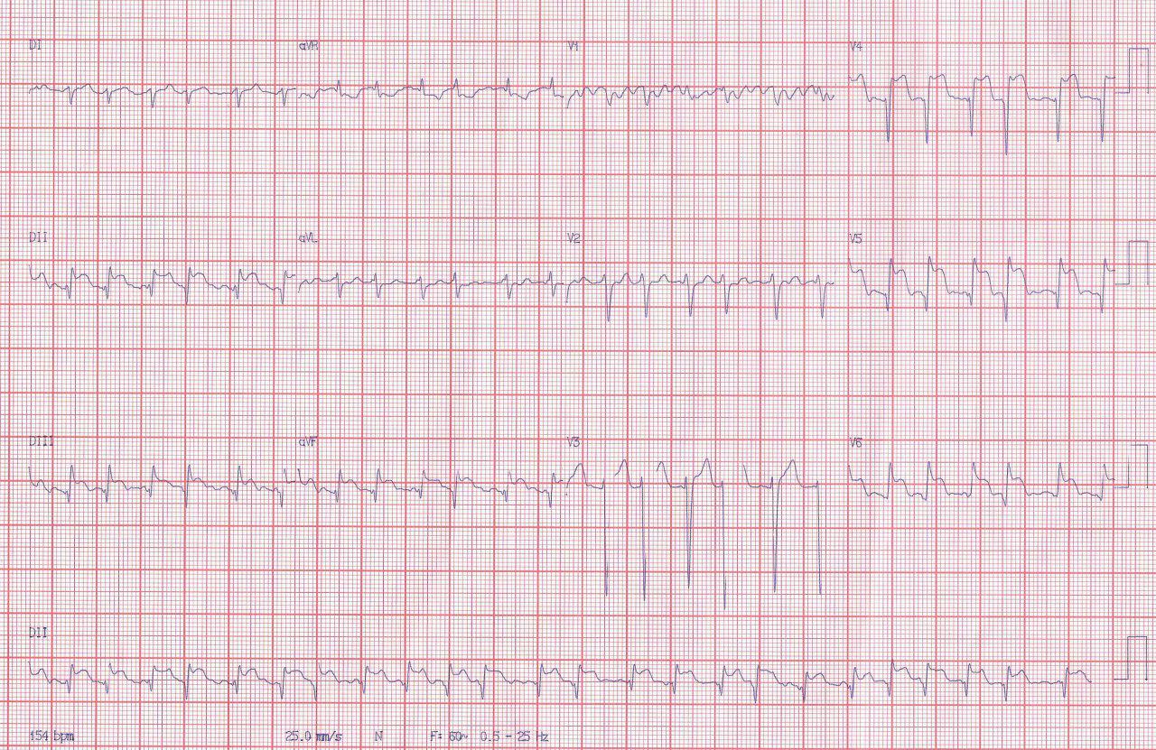 Paciente de 36 años portador de doble prótesis mitral y aórtica, anticoagulado, que presenta cuadro de SCA por embolia en DA distal