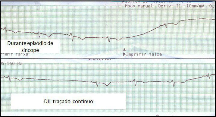 Paciente de 21 años tratada con anticonceptivos que presenta episodios sincopales y disnea debidos a TEP que requiere tratamiento con streptoquinasa a pesar de lo cuál fallece