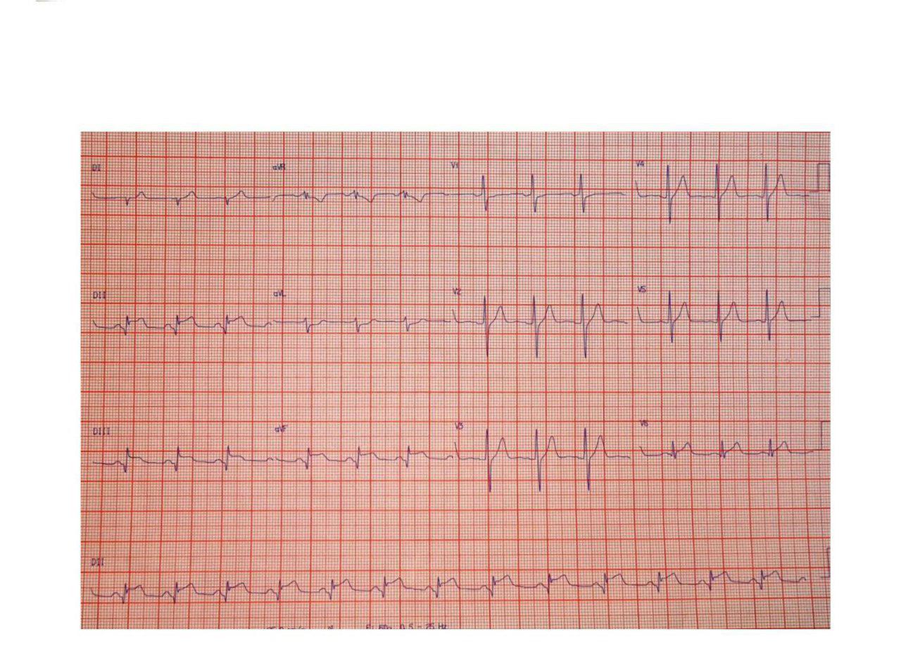 Paciente de 25  años con angor prolongado con elevación de troponina en el que se detecta origen anómalo de CD