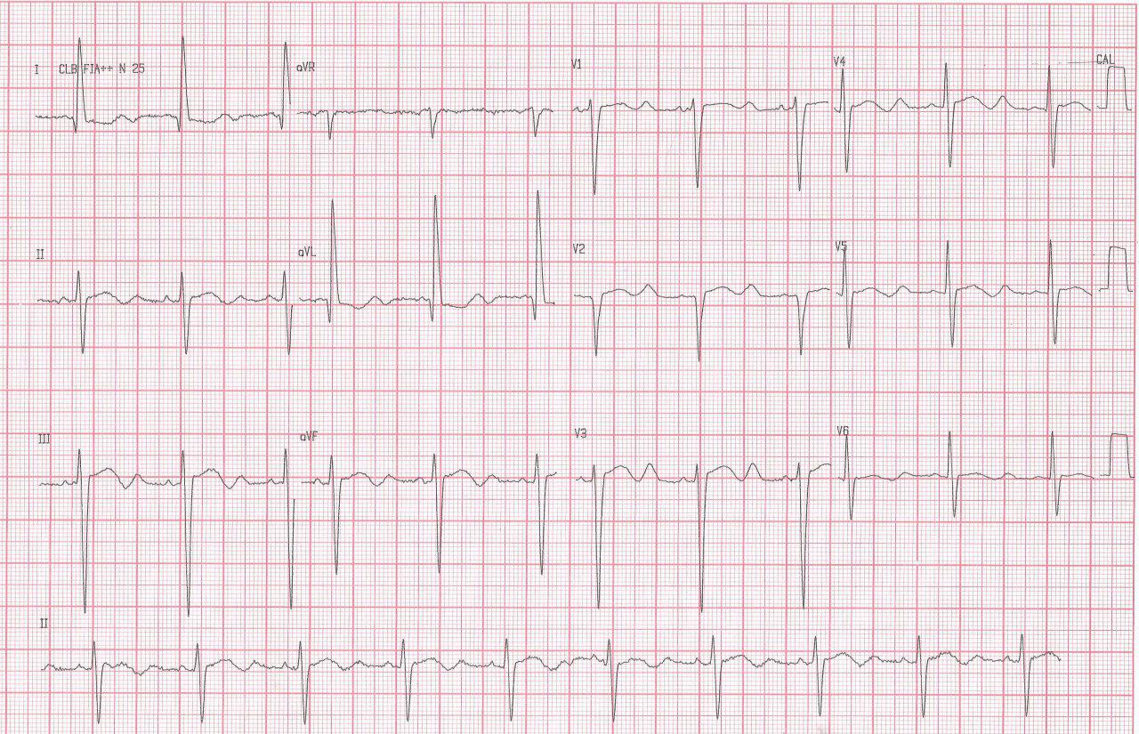 Anciano con debilidad muscular por hipopotasemia de 1,7 meq/l que presenta onda U gigante en el ECG