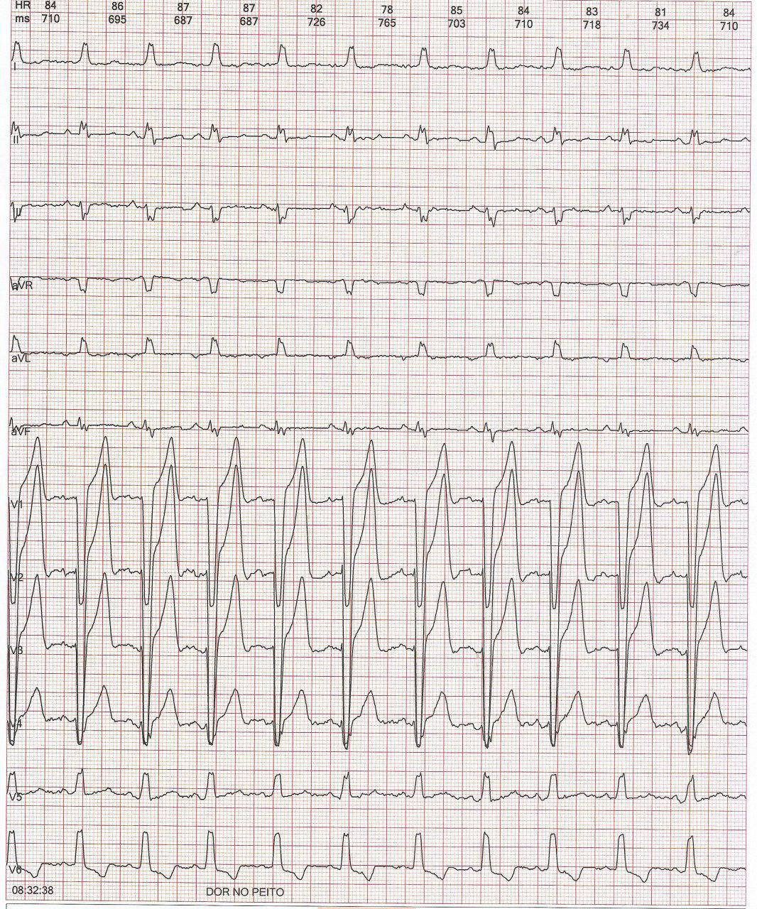 Mujer de 22 años que presenta dolor toráccico con taquicardia y BCRI en fase 3 en el ECG que desaparece mostrando fenómeno de memoria de la Onda T