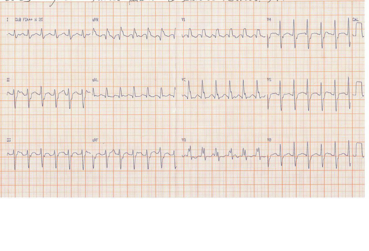 Mujer joven sin cardiopatía estructural con palpitaciones por TV fascicular