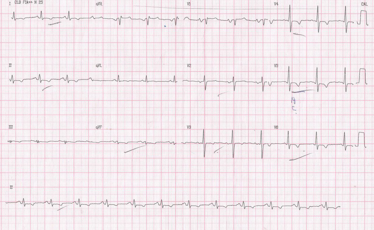 Paciente de 33 años con disnea progresiva y edemas en MI por pericarditis constrictiva