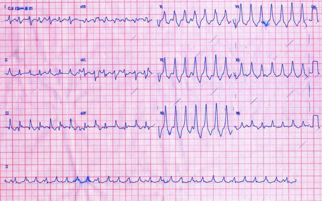 Mujer de 47 años con enfermedad de Chagas con palpitaciones y síncope por TV originada en aneurisma y bloqueo de rama bilateral
