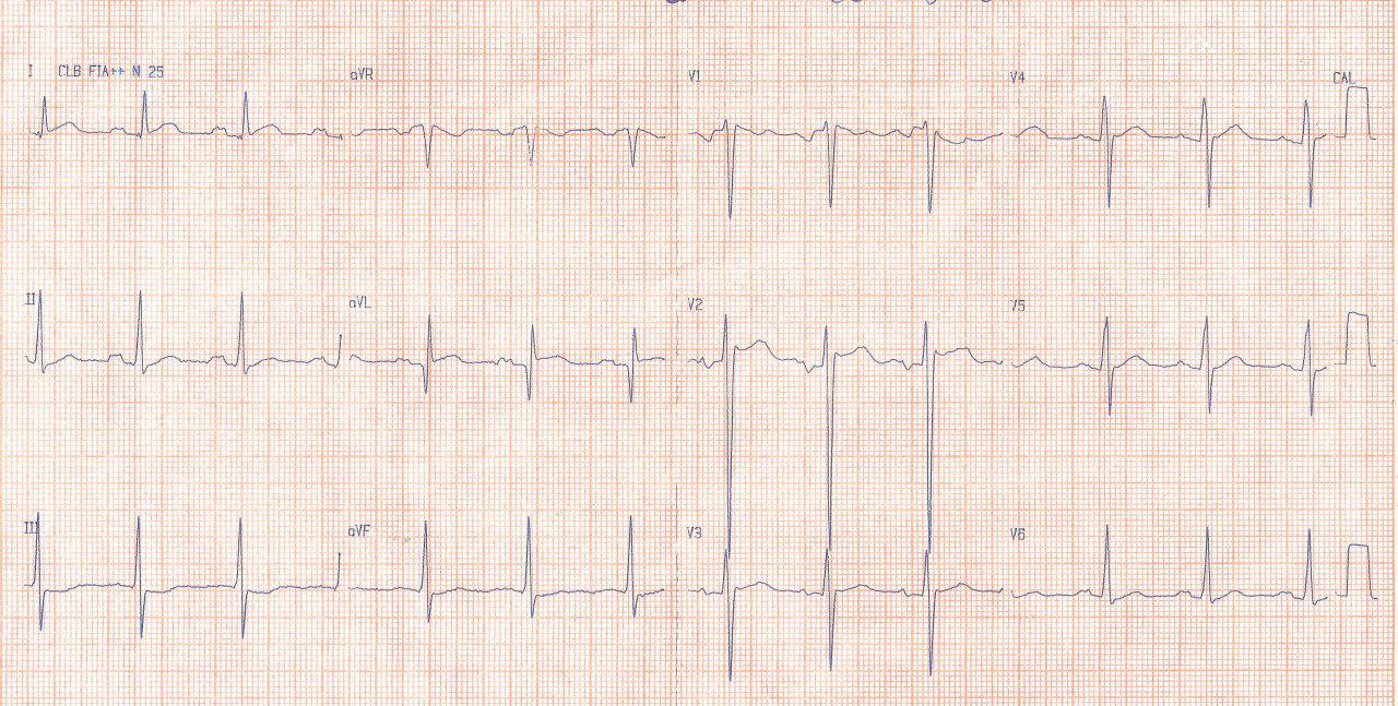 Mujer de 29 años con angor y disnea progresivos por miocardiopatía hipertrófica asimétrica que presenta episodios de TV