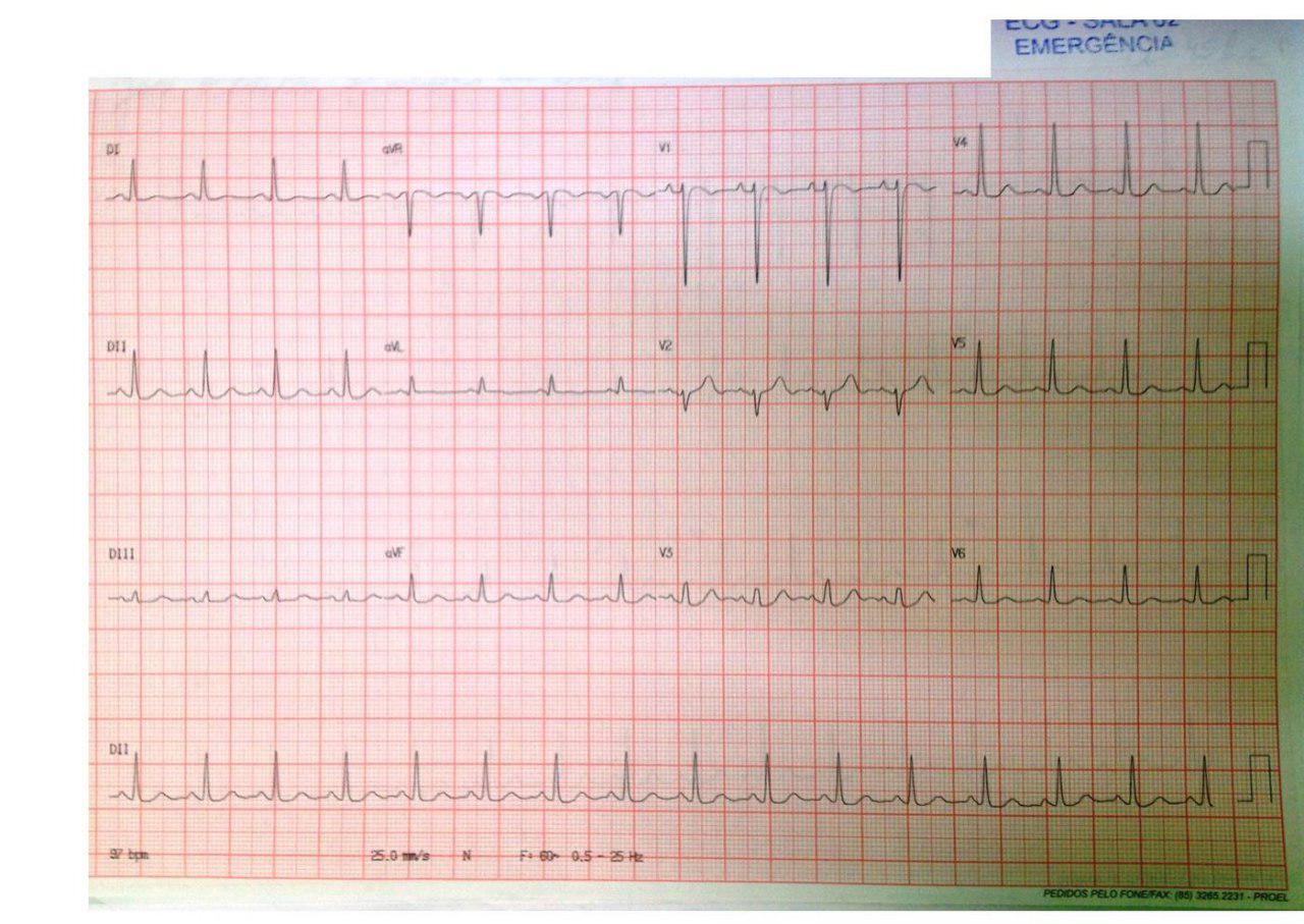 Paciente de 44 años que presenta síncope maligno por FV que logra revertirse detectándose a posteriori EVs con fenómeno R/T